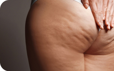 RÉDUIRE LA CELLULITE CONSEILS ET SOLUTIONS